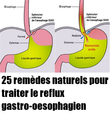 Rem Des Naturels Pour Traiter Le Reflux Gastro Oesophagien Sant