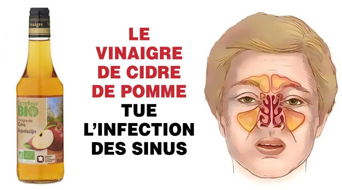 Comment Tuer Une Infection Des Sinus En Quelques Minutes Avec Du