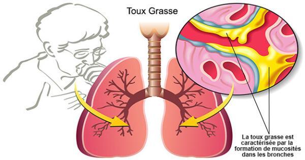 Les Meilleurs Remèdes Naturels Contre La Toux Grasse Santé Nutrition 